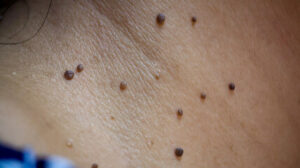 Skin Tag Removal